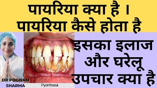 पायरिया क्या है  पायरिया कैसे होता है  पायरिया का इलाज और घरेलु उपचार  Treatment Of Pyorrhea [upl. by Arny]