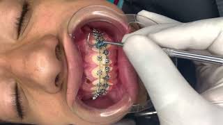 🔥NO se esta cepillando los dientes tiene una MALA limpieza con brackets 😬🔥 [upl. by Tersina]