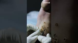 Effective Plantar Wart Removal Treatment at Skinaa Clinic  Say Goodbye to Painful Warts viral [upl. by Pietrek708]