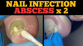 Ingrown Nail Infection Abscess  Second Nail Will Shock You [upl. by Jarrell]