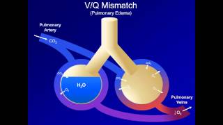 Hypoxia and Hypoxemia Mechanisms and Etiologies ABG Interpretation  Lesson 18 [upl. by Brinn579]