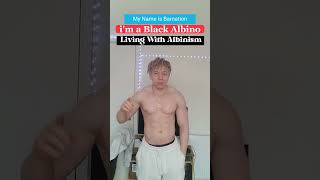 Living with Albinism From A Black Albino Dark Humour 2023 [upl. by Marcela]