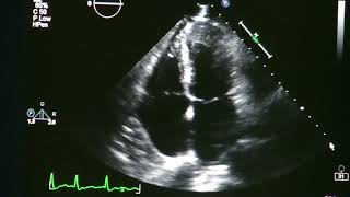 Atrial Fibrillation On Echocardiogram [upl. by Kotto]