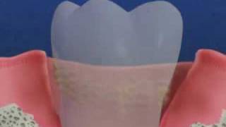 Periodontal Disease amp Treatment [upl. by Swihart]