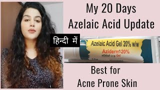 Azelaic Acid Update20 Days Update Of Azelaic Acid aziderm AzelaicAcid Acne pigmentation scar [upl. by Haikan]