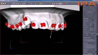 Indywidualnie Projektowane Aparaty Ortodontyczne IPA [upl. by Meggi]