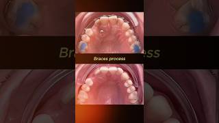 How to pull hidden teeth pull hiddenteeth dentist orthodontist braces dentisty [upl. by Aiouqahs]