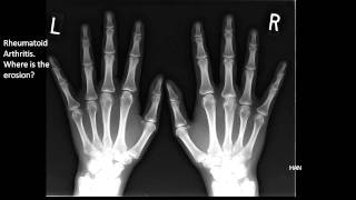 Image of the Month Rheumatoid Arthritis XRay [upl. by Aener869]