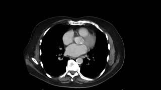 IgG4 related disease [upl. by Yesllek]