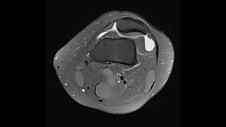 Trochlear dysplasia [upl. by Lanette]