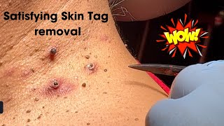 Amazing Satisfying Skin Tag Removal [upl. by Queenie]