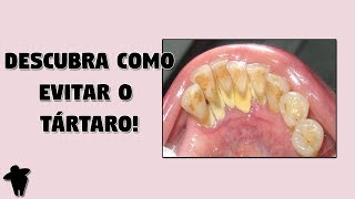 Como Tirar Tártaro dos Dentes em Casa  Descubra Como Evitar o Tártaro e Se Livrar Deste Problema [upl. by Stortz]