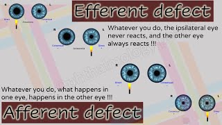 Pupil 2  Characteristics of Afferent and Efferent Pupillary Defects [upl. by Vashti799]