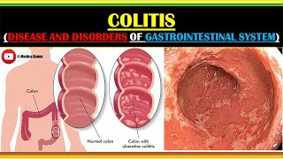 COLITIS  TYPES OF COLITIS  CAUSES OF COLITIS  PATHOPHYSIOLOGY OF COLITIS  MANAGEMENT OF COLITIS [upl. by Prakash]