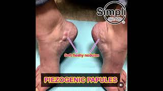 Piezogenic Pedal Papules [upl. by Ialda]