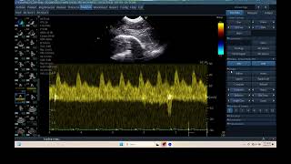 IQ 305 TCD BRAIN ULTRASOUND ICP CPP ECHOPAC ANALYSIS [upl. by Raimondo]