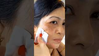 How to get rid of pigmentation and acne scars naturally at home ytshorts viral [upl. by Neiht]