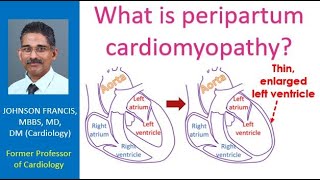 What is peripartum cardiomyopathy [upl. by Enitsenre]