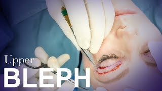 Upper Eyelid Blepharoplasty [upl. by Cora]