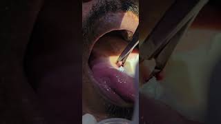 Leukoplakia toungue Laser  Cautery  Dr Hitesh Patel [upl. by Ijic805]