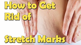 How to Get Rid of Stretch Marks For Teenagers Fast At Home [upl. by Airrotal]