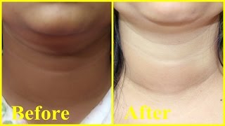 Dark Neck Dont Worry  Miracle Remedy to get Fair Neck 100 Effective Natural Home Remedy [upl. by Swanson]