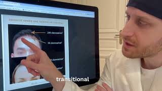 Hair transplant is not a good option for forehead reduction Dr Abbou Paris [upl. by Liartnod]