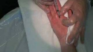 Palmar Hyperhidrosis Botox Procedure [upl. by Olecram]