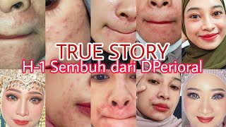 Dermatitis Perioral Sudah Fix Sembuh Jalan 5 Bulan My True Experience [upl. by Anaed]