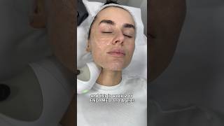 Amber Davies EndyMed Facial Tightening amp AgeJet Second Session at Dr MediSpa [upl. by Odyssey]