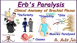 Erbs paralysisBrachial Plexus InjuryErbs PalsySimplified Anatomy Deformity Disabilityin hindi [upl. by Amadis]