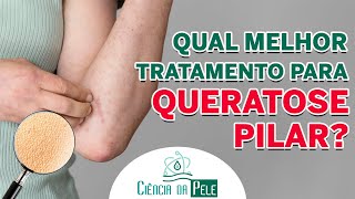 Como Tratar Queratose Pilar PRODUTO INDICADO POR ESPECIALISTAS [upl. by Alram]