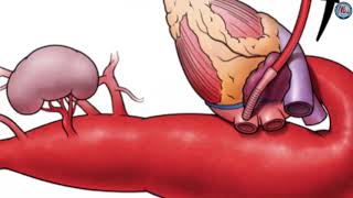 Thoracoabdominal aortic aneurysm repair in Marfan Syndrome How we do it [upl. by Lefton]