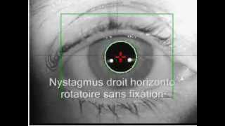 Nystagmus horizontal et rotatoire sans et après fixation [upl. by Attaynek502]