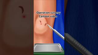 Operation surgery cartoon shortvideos [upl. by Petrine60]