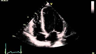 HYPERTENSIVE CARDIOMYOPATHY [upl. by Aicerg865]