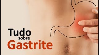 TUDO SOBRE GASTRITE  SINAIS SINTOMAS E TRATAMENTO  Dr Marcelo Lima [upl. by Annaig]