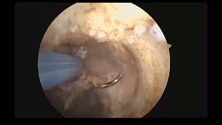 Hysteroscopic Istmocele Operation [upl. by Aurlie]