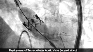 SAPIEN TAVR Deployment Under Flouroscopy Ultrasound [upl. by Annairdna]