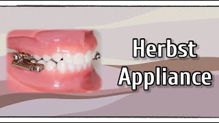 Herbst Appliance [upl. by Nahsad]