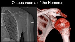 Osteosarcoma of Proximal Humerus [upl. by Yecac]