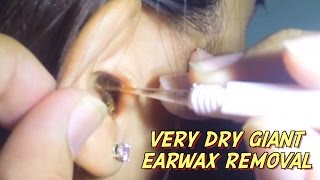 Very Dry Giant Earwax Removal [upl. by Nyved]