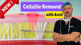 Aveli Cellulite Reduction [upl. by Meisel]