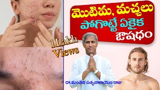 How To Remove Pimples Overnight  Acne Treatment  Dr Manthena Satyanarayana Raju  GOOD HEALTH [upl. by Attesor]