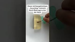 GEFÄHRLICHER AUSSCHLAG  Wann du sofort zum Arzt musst 👩‍⚕️👶 kindermedizin elterntipps [upl. by Cheslie59]