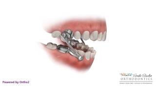 Herbst  Orthodontic Appliance [upl. by Auqenwahs]