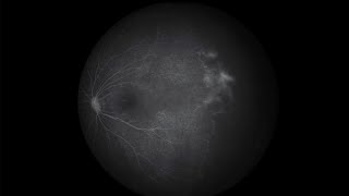 Dynamic View of the Floating Retinal Veins [upl. by Naylor]