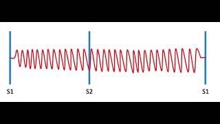 Gibson Or Machinery Murmur  Indication of patent ductus Arteriosus [upl. by Lamrej]