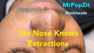 Nose extractions Blackheads whiteheads miliaKeratin plugs extracted with deep squeeze Pore dirt [upl. by Nerac]