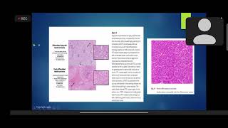 Poorly differentiated thyroid cancer management PDTC  Practical Implications Dr Saumyta [upl. by Anim]